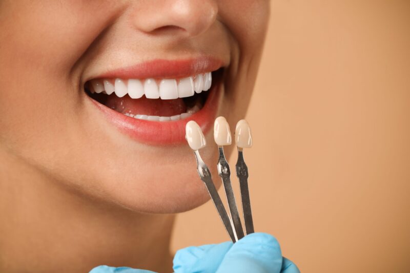 Dental Veneers Katy