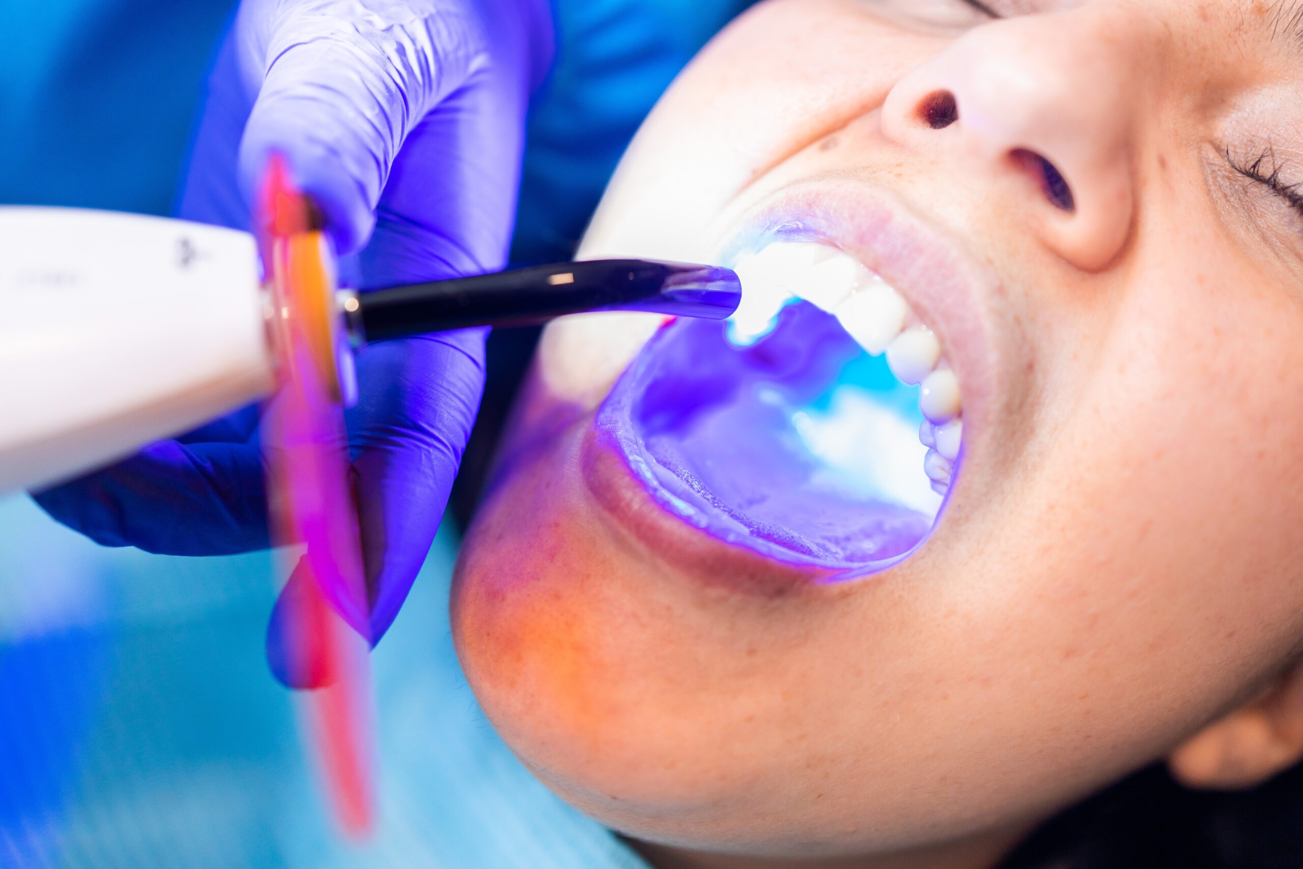 Dental Fillings Katy