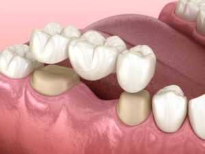 Dental Crowns and Bridges Katy